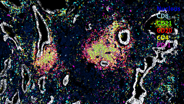 人肺癌组织 6标7色