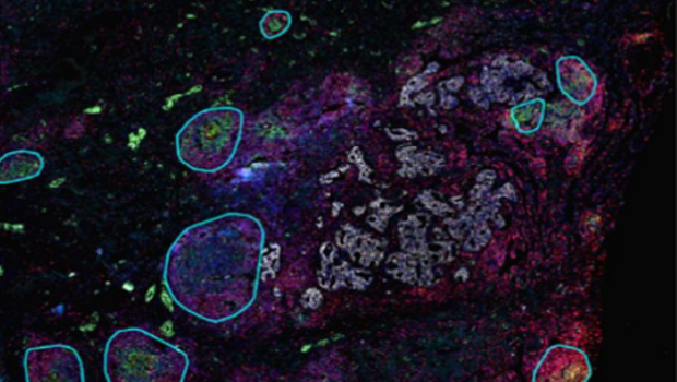 三级淋巴结构（TLS）分析