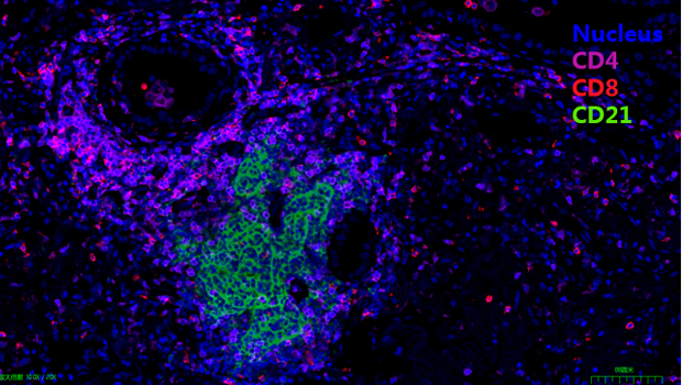 人肺癌组织  3标4色
