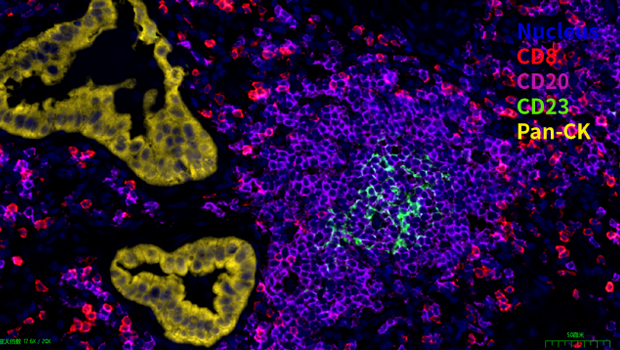 人肺癌组织  4标5色