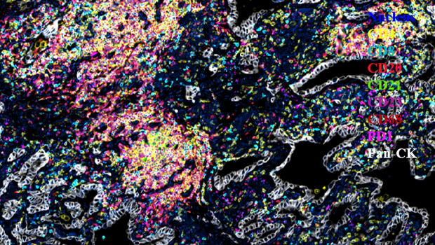 人肺癌组织  8标9色